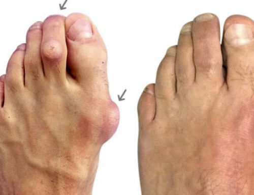 Are You Dealing With Bunion Pain?