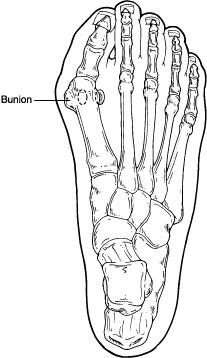 bunions What is a Bunion