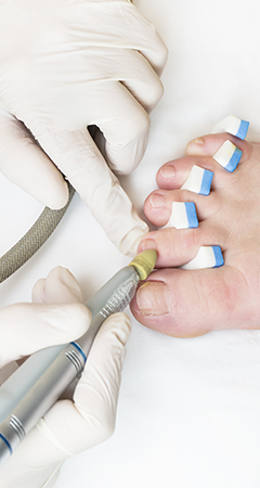 The treatment for toenail fungal infection